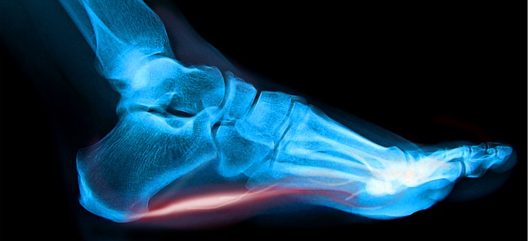 Plantarfasciitis xray with red ligt