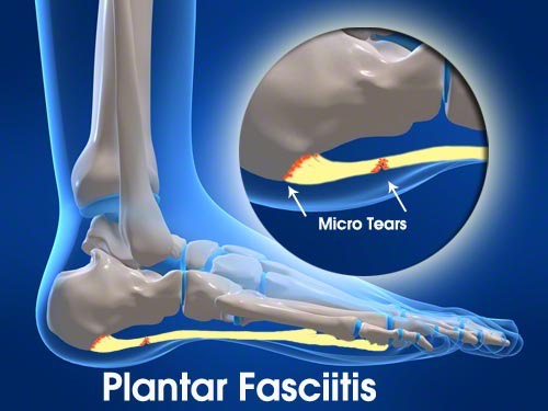 plantarfasciitis